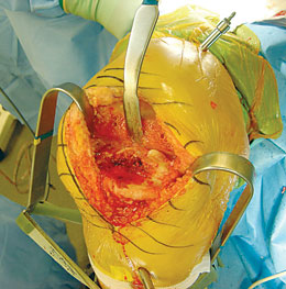 Long Prong Collateral Ligament Retractor