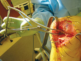 Stubbs Short Prong Collateral Ligament Retractor