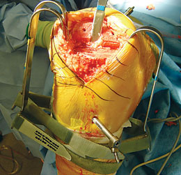 Knee Retractor System