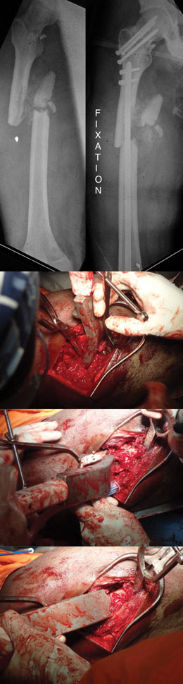 AK Fracture Reducer