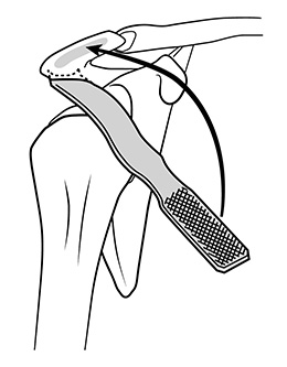 Acromioplasty Retractor