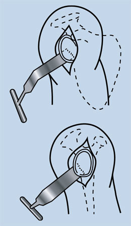 Agrawal Talon Retractor