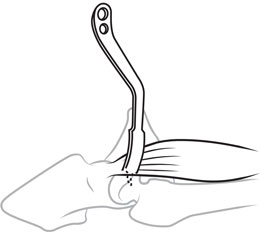 Alvi Modified Hohmann Retractor
