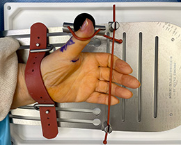 Auerbach Hand Positioner Set