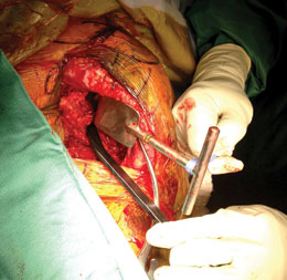 Axillary Nerve Protector