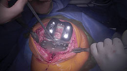 Bacastow Tibial Plateau Elevators