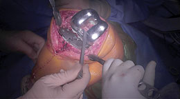 Bacastow Tibial Plateau Elevators