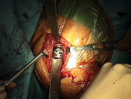Bacastow Glenoid Retractor