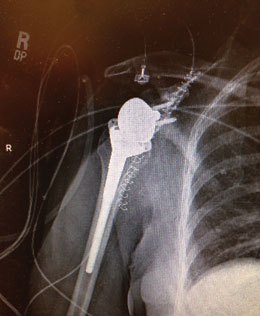 Bacastow Glenoid Retractor