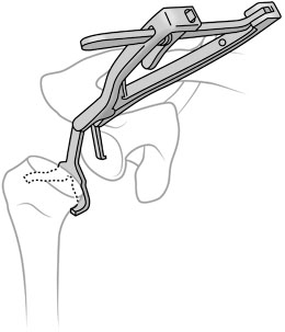 Bacastow Shoulder Capsular Retractor