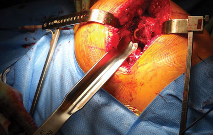 Bozeman Anterior THA Femoral Elevator