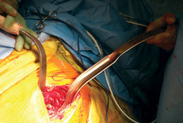 Bozeman Anterior THA Femoral Elevator 