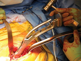 Bozeman Anterior THA Femoral Elevator 