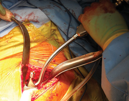 Bozeman Anterior THA Femoral Elevator 