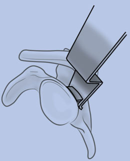 Burkhead Glenoid Retractor