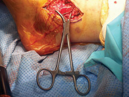Calvo Medial Malleolus Fracture Clamp