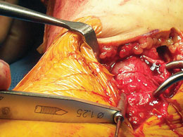 Calvo Medial Malleolus Fracture Clamp