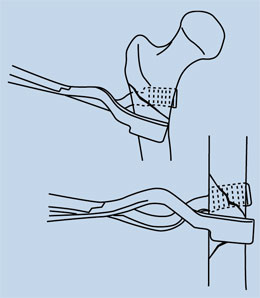 Cannestra Trochanteric Fracture Reduction Clamp