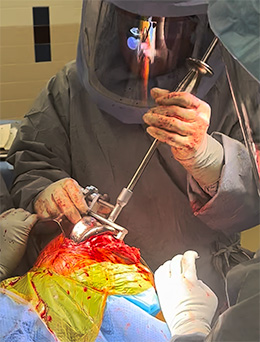 Cannestra TKA Implant Extractor