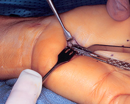 Broach Extraction OrthoVise