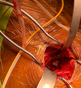 Chandran Anterior Retractor for THR