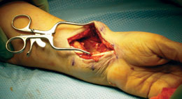 Chung Weitlaner Retractor