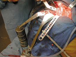 Deep Cobra Retractor