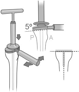 Colwell TKA 5° Tibial Rasp Assembly