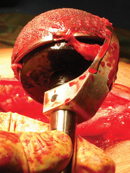 CupX — Acetabular Cup Extraction System