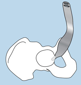 Curved Cobra Retractors