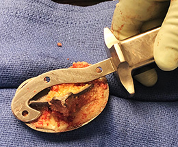 Curved Osteotome for Total Knee Revision
