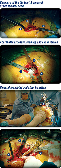Das Anterior Total Hip Instruments
