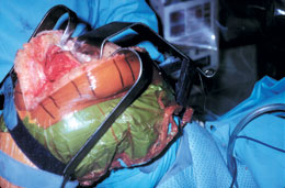 Wide PCL Retractor