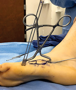 Desai Jones Fracture Reduction Clamp