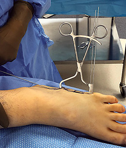 Desai Jones Fracture Reduction Clamp