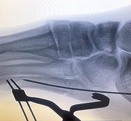 Desai Jones Fracture Reduction Clamp