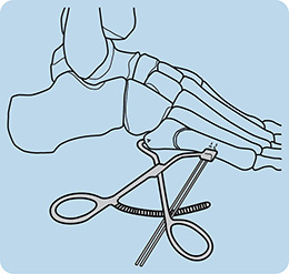 Desai Jones Fracture Reduction Clamp