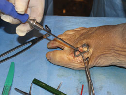 Duncan Metatarsal Clamp