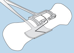 Duncan Metatarsal Clamp