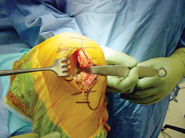 Engh Intercondylar Notch Retractors