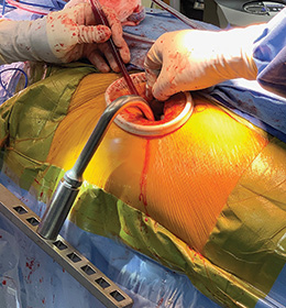 Extension Set for Anterior THR Tables
