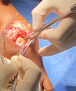 Faillace Bone Impact/Graft Forceps