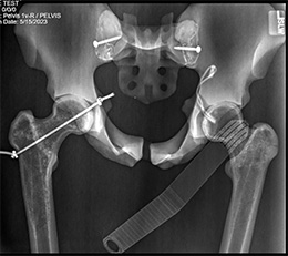 Fajardo Femoral Neck Reference Retractor for Anterior THA