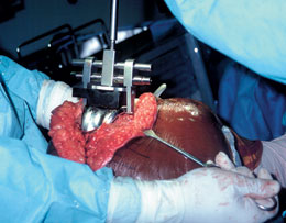 Femoral Component Extractor