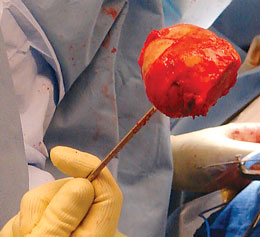 Femoral Head Removal Pin