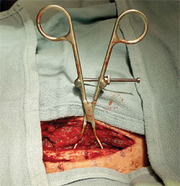 Chung Weitlaner Retractor 