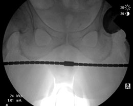 Anterior Hip Referencing Rod Assembly
