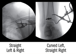 Chung Weitlaner Retractor 