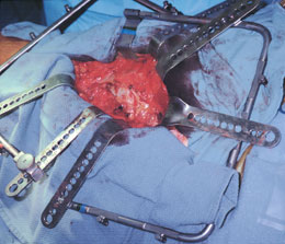 Hip Surgery Retractor System