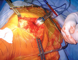 Hip Surgery Retractor System